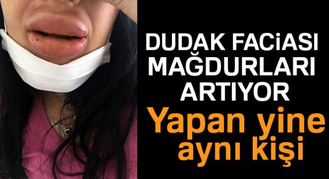 Dudak faciası mağdurları artıyor