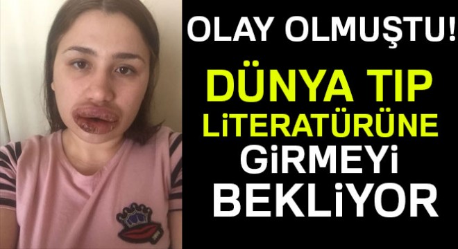 Merve Keleş'in dudakları dünya tıp literatürüne girmeyi bekliyor